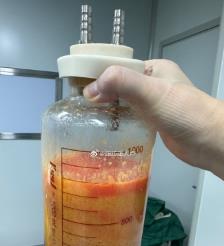 定安水动力吸脂手术要做多久？